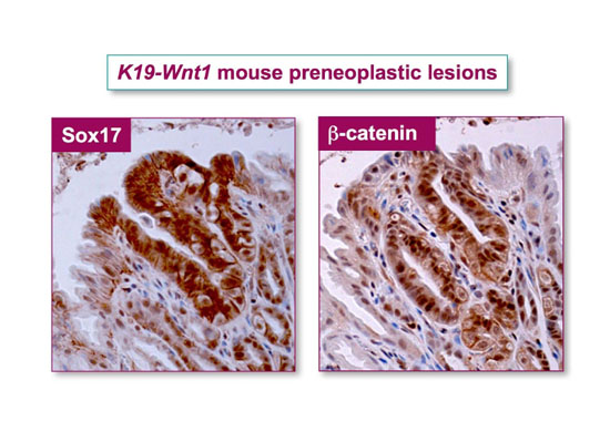 消化管腫瘍発生におけるSox17発現の関与